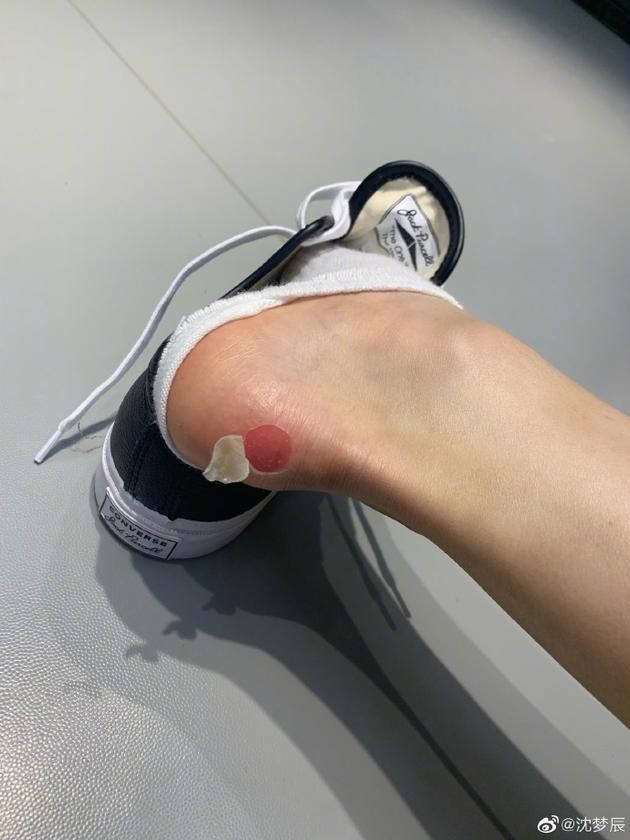 沈梦辰脚后跟被磨起泡：你看这个泡它又大又圆