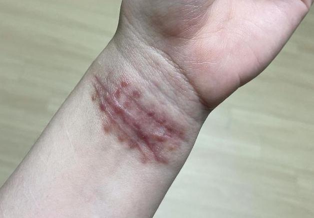 权珉娥自曝被欺凌后发照 手腕处伤疤太惊心！