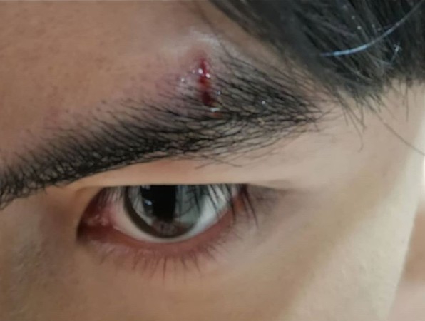 唐禹哲拍戏片场意外受伤，眉上流血差点伤到眼睛